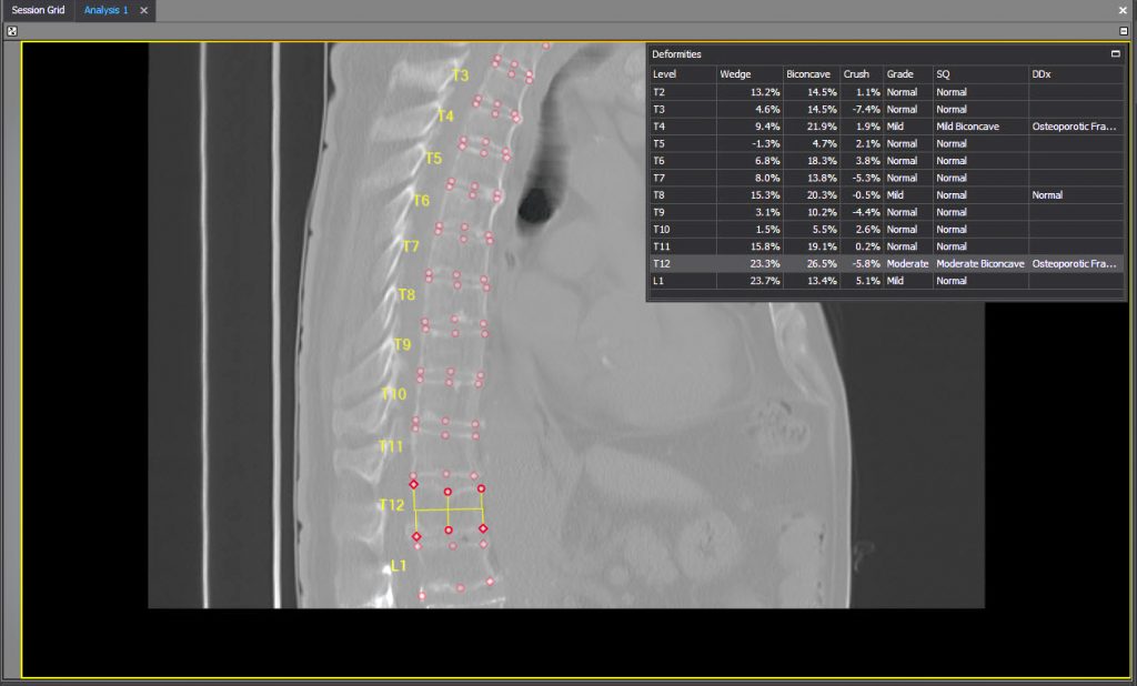 The Algorithm that can Stop your Future Hip Fracture