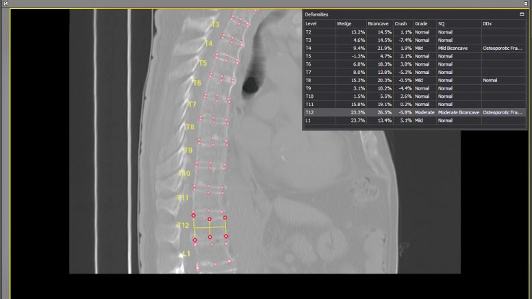 AI Service Detects Vertebral Fractures in more than 2,000 Patients