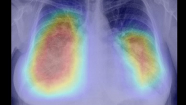 AI Tool Shows Potential to Improve Speed of Lung Cancer Detection