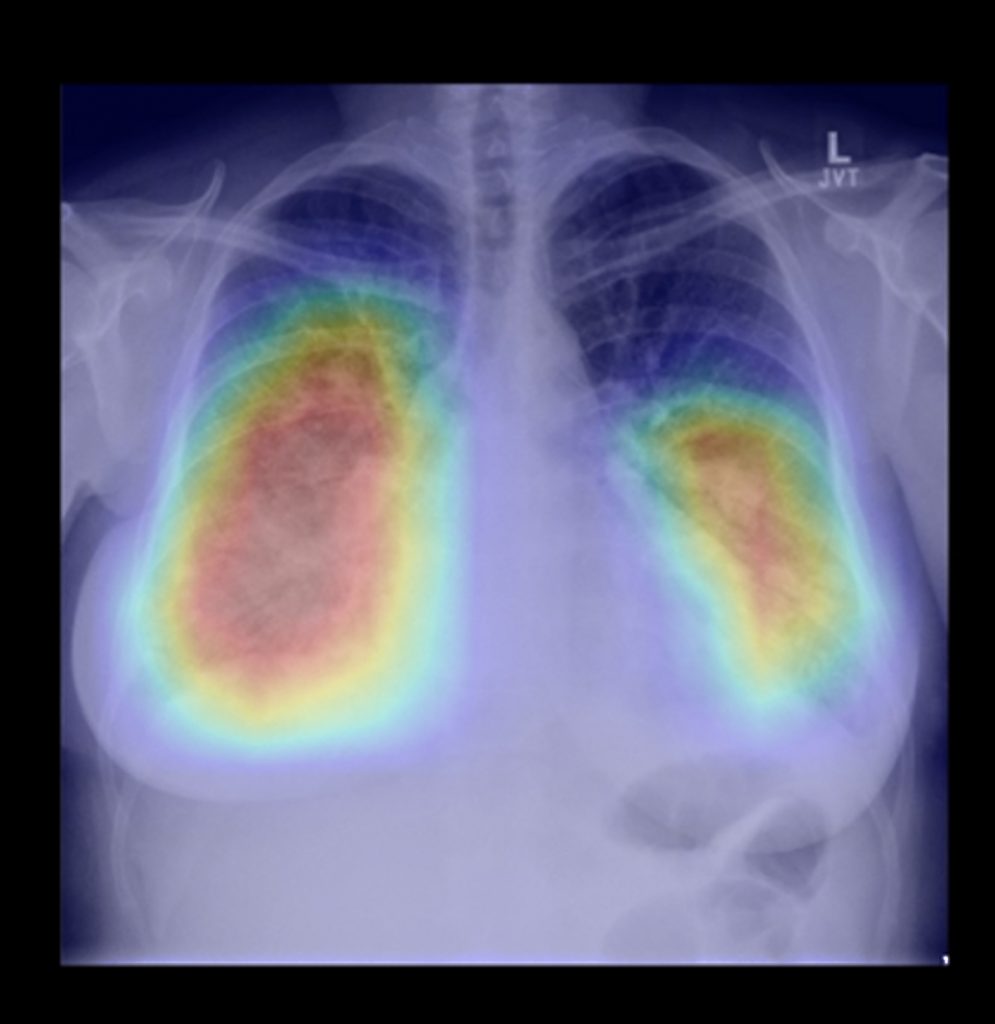 AI Tool Shows Potential to Improve Speed of Lung Cancer Detection