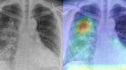 Collaboration Aims to Fast-track AI Solution for Rapid COVID-19 Diagnosis Using Chest X-rays