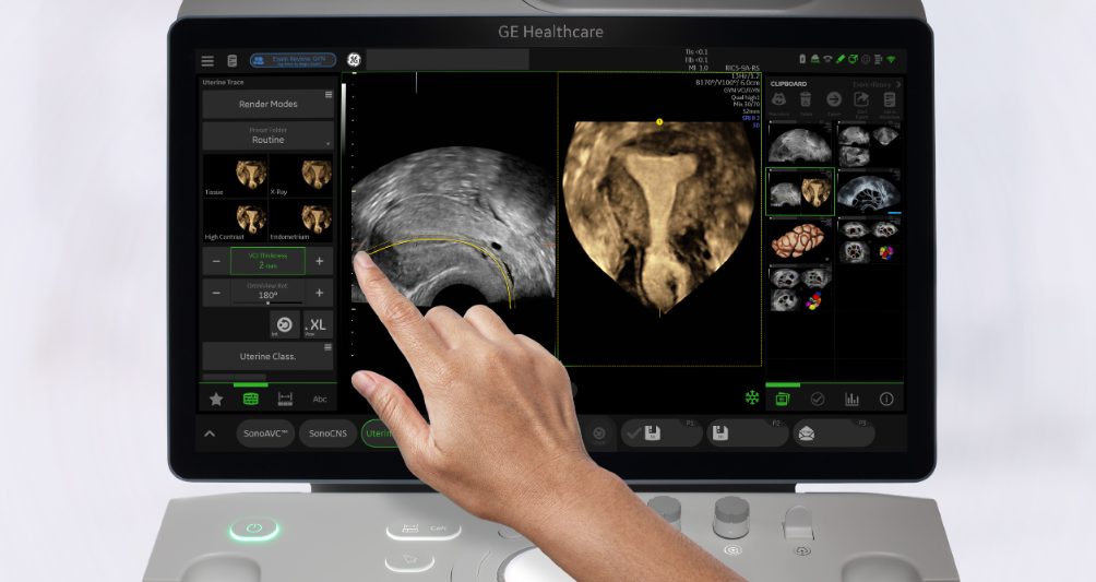 GE Healthcare Unveils AI-Enhanced Women’s Health Ultrasound