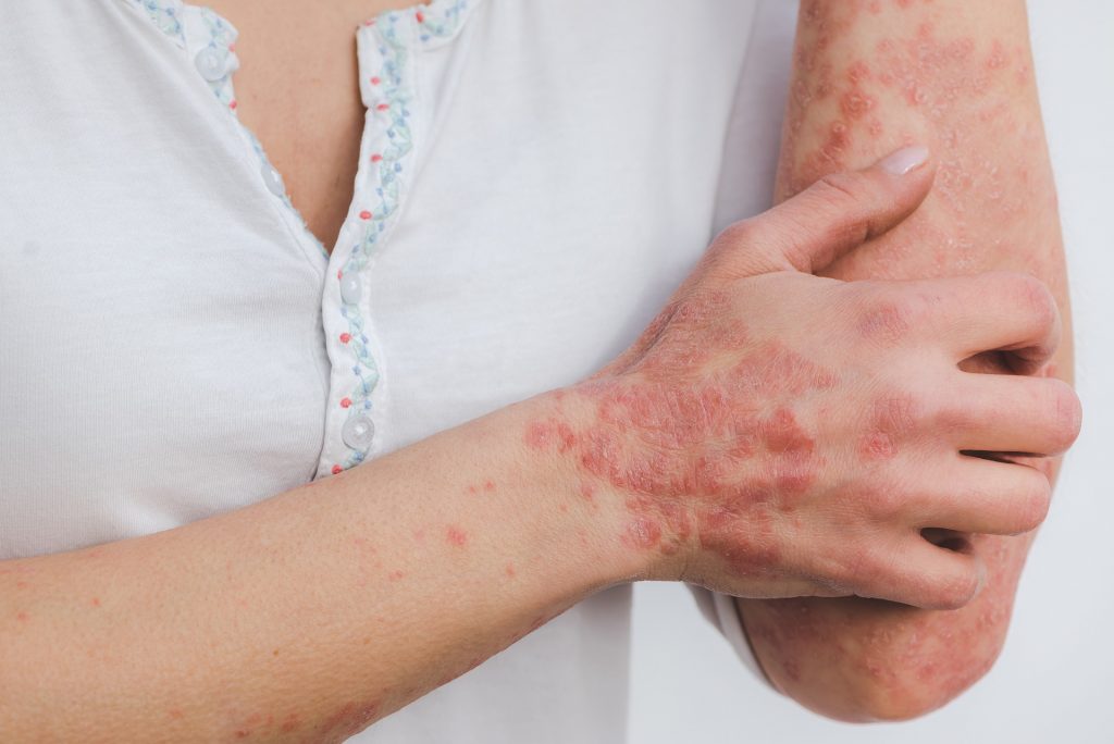 Experts Launch First-of-its-Kind Digital Tool to Support Psoriasis Patients