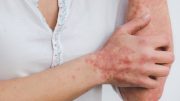 Experts Launch First-of-its-Kind Digital Tool to Support Psoriasis Patients