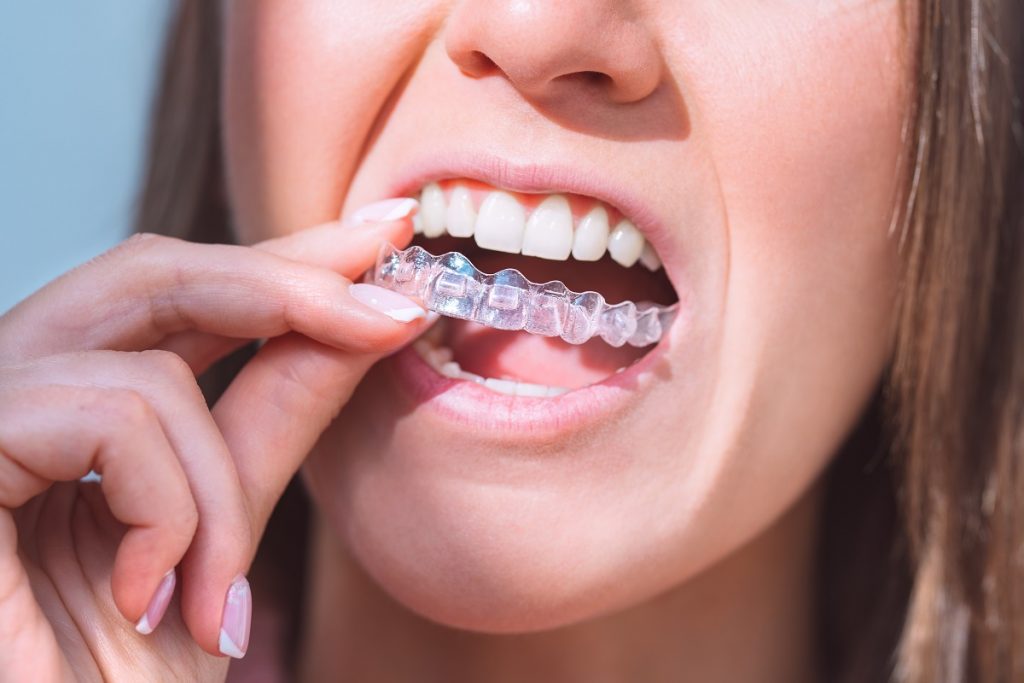 Factors That Affect The Cost of Invisalign in Malaysia