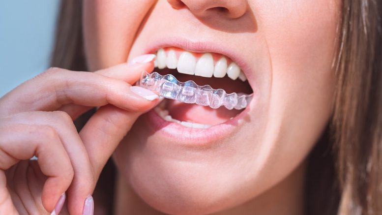 Factors That Affect The Cost of Invisalign in Malaysia