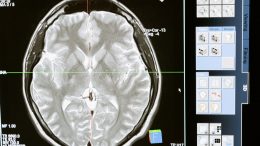 Long-Term Effects of a Brain Injury