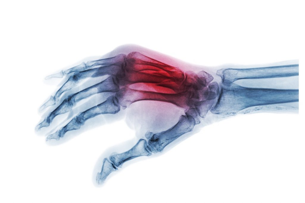 Scaphoid fractures