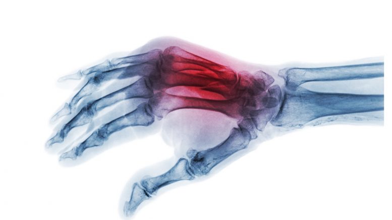 Scaphoid fractures